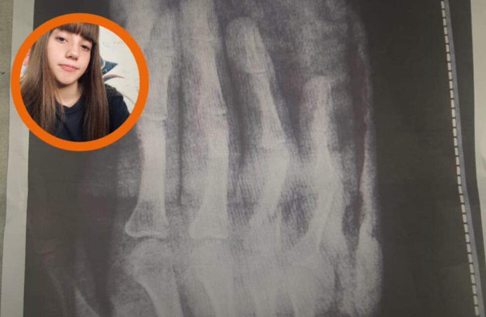 Puntaltense necesita con urgencia operarse de la mano y debe juntar más de 3 millones