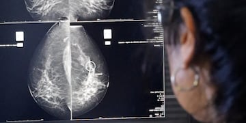 Con la cobertura del Programa de Control de Cáncer de Mama, en el último año se incrementó un 50% la cantidad de mamografías realizadas en toda la provincia, llegando a un total de 5.600 estudios solo en el ámbito público.