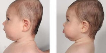 Plagiocefalia, la rara afección que afecta a una beba de 13 meses de San Luis.