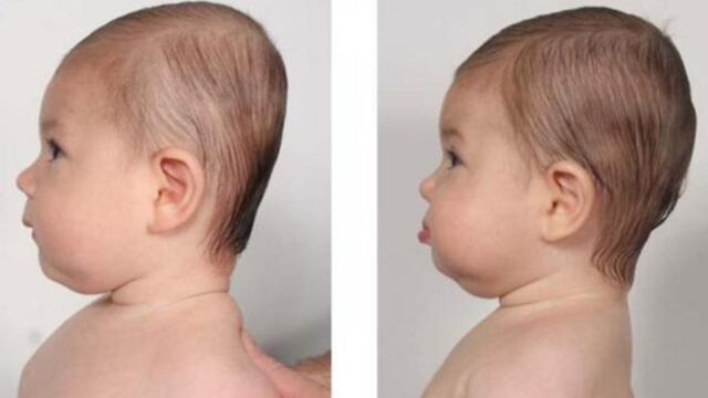 Plagiocefalia, la rara afección que afecta a una beba de 13 meses de San Luis.