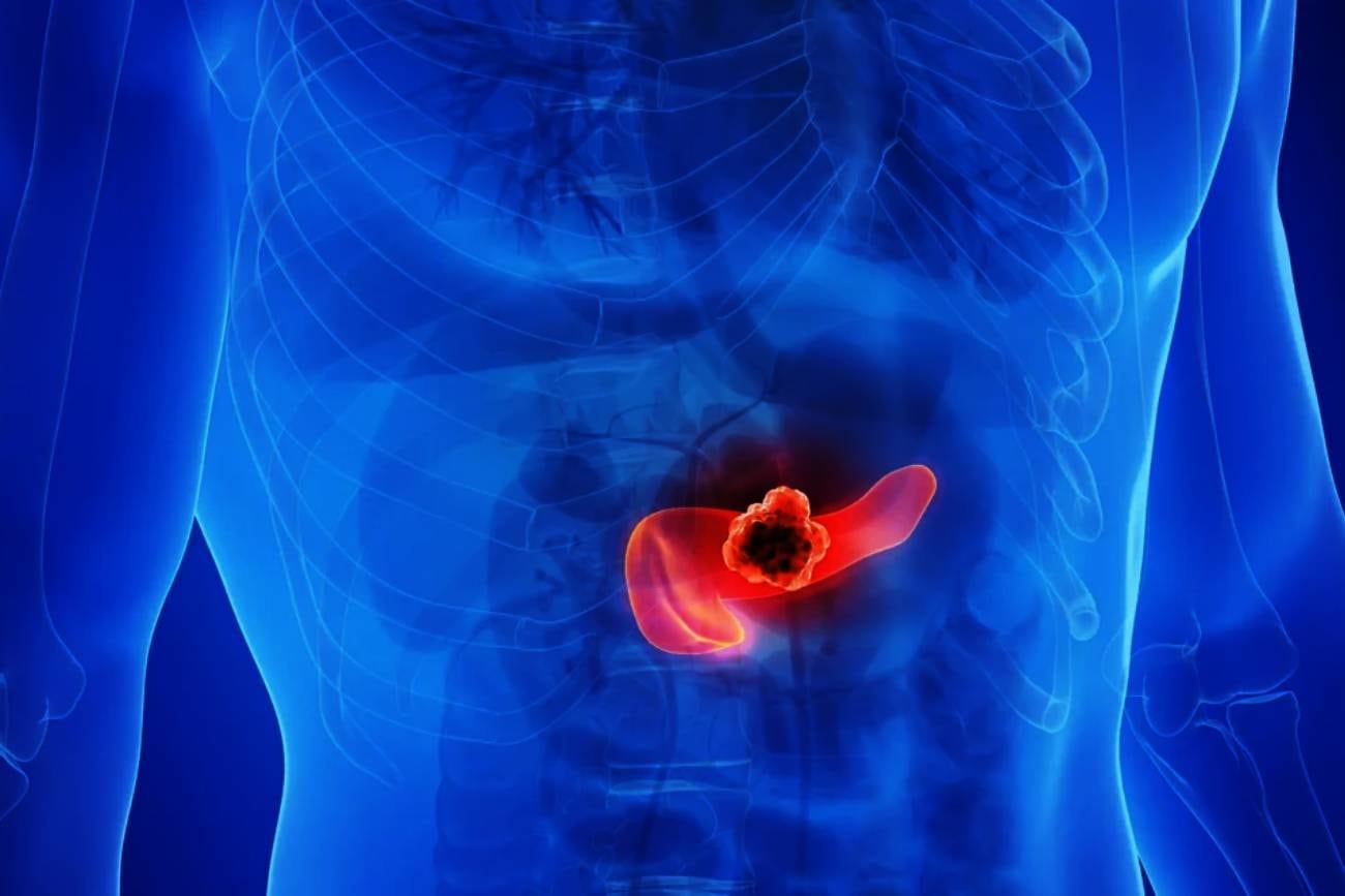 Cáncer de páncreas. Imagen ilustrativa sobre el avance del tumor. (Centro Médico ABC)