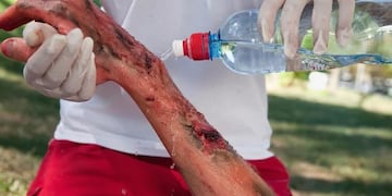 Un hombre fue encontrado en un basural de Junín, Mendoza con quemaduras de tercer grado.