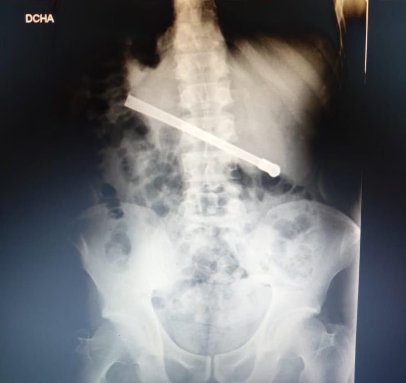 La radiografía que mostró la bombilla atravesada en la cavidad toráxica.