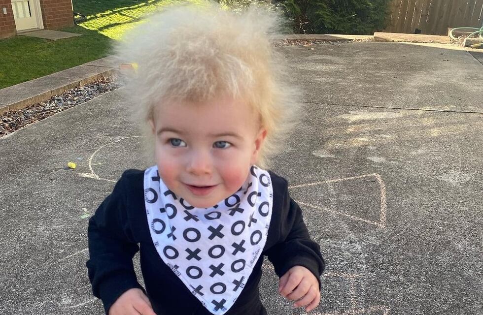 Tiene 16 meses y padece del “Síndrome del Cabello Impeinable”: Qué es