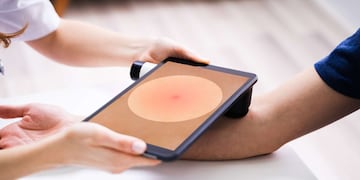 La hidradenitis supurativa es una enfermedad inmunológica y crónica de la piel.
