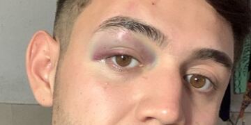 Joven golpeado en un boliche de Carlos Paz