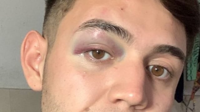 Joven golpeado en un boliche de Carlos Paz