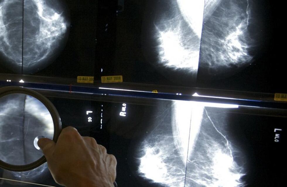 Mamografias en Cura Brochero