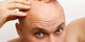 El estrés es una de las causas de la calvicie a temprana edad