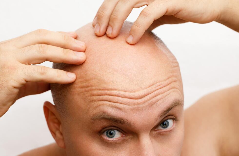 Video: quería ocultar su calvicie y esta fue su decisión permanente que lo volvió viral