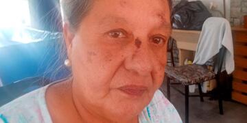 Patricia cayó del colectivo 52 y acusa al chofer por una maniobra brusca que pudo costarle la vida.