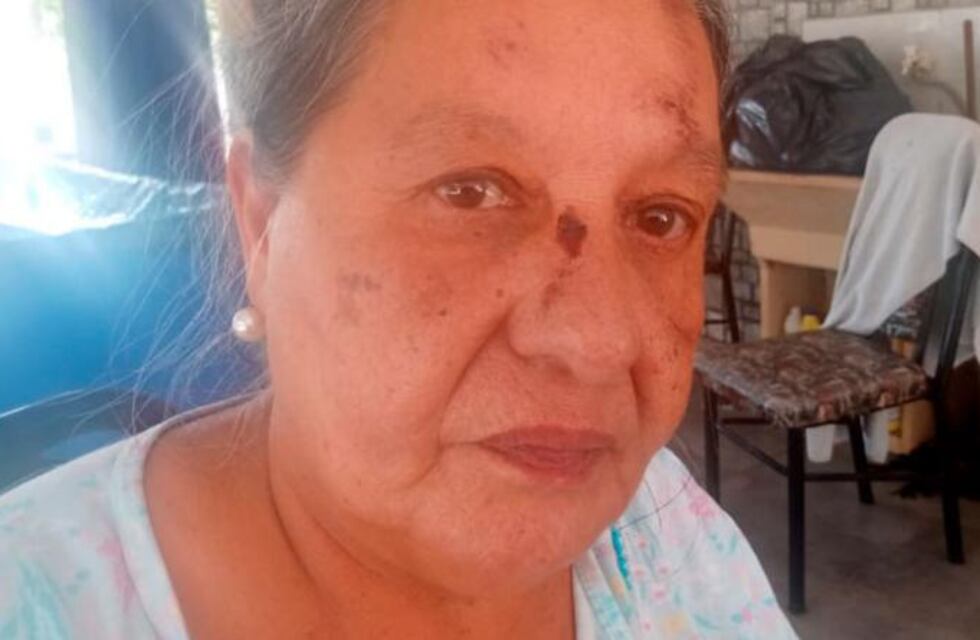 Córdoba: se cayó del colectivo y acusa al chofer por el accidente que pudo costarle la vida