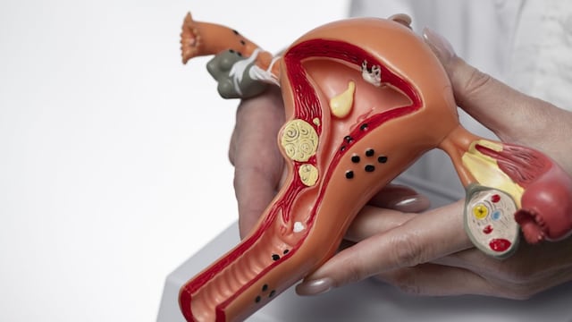 Cáncer de Cuello Uterino