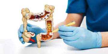 El Día Mundial del Cáncer de Colon se celebra el 31 de marzo para concienciar sobre la necesidad de tomar medidas para prevenirlo y también promover la detección precoz.