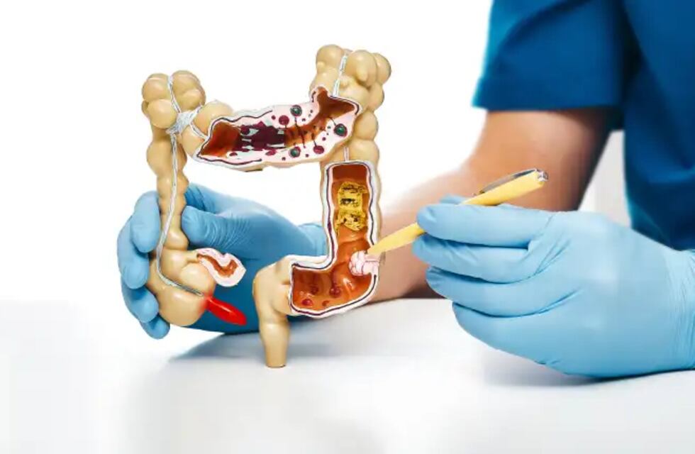 Día Mundial del Cáncer de Colon: cuáles son los exámenes para esta enfermedad que aumentó su diagnóstico en jóvenes