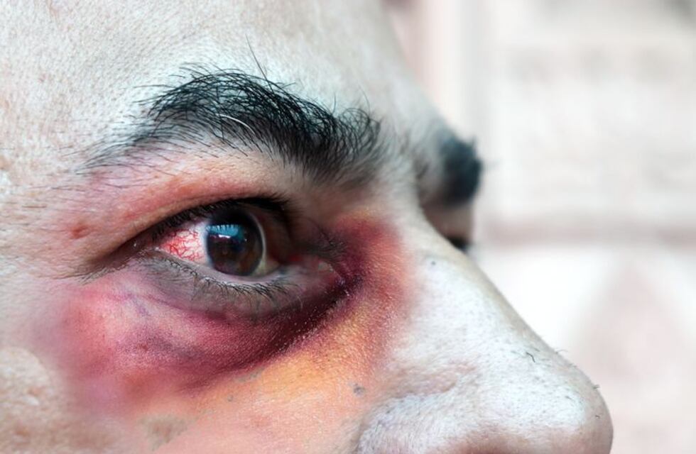 Se detectó en la Argentina el primer caso de “hongo negro” por coronavirus