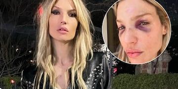 El terrible accidente de Chloé Bello