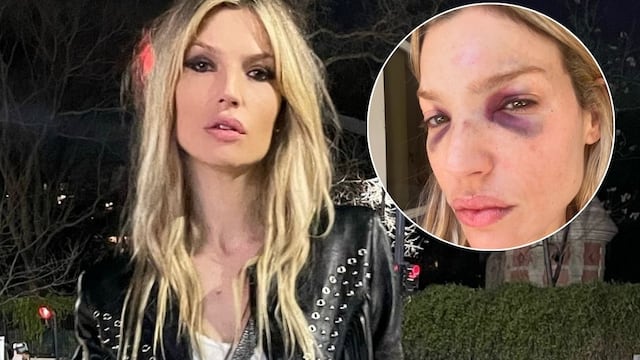 El terrible accidente de Chloé Bello