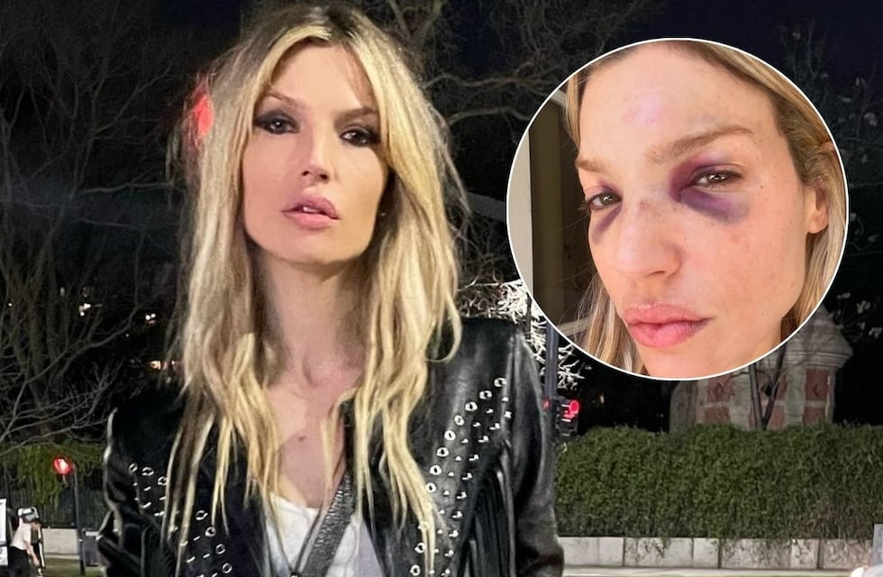 VIDEO | El terrible accidente que sufrió Chloé Bello, la última novia de Gustavo Cerati