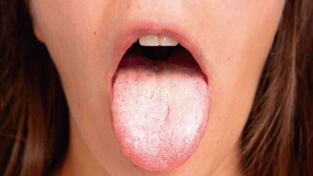 Qué significa tener la lengua blanca, según los expertos.