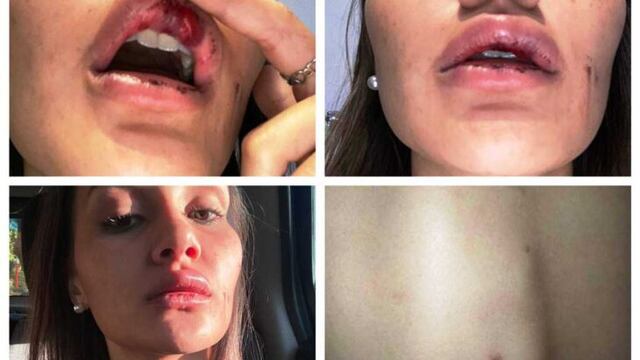 El agresor le dio entre 15y 20 piñas en el rostro