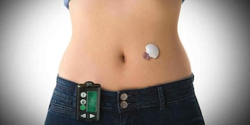 La joven necesita la bomba de insulina las 24 horas del día