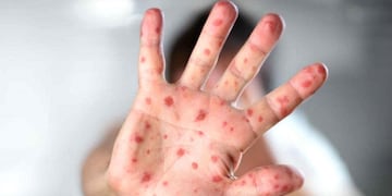 Alerta por Sarampión en Entre Ríos: el Ministerio de Salud provincial advirtió sobre posible exposición