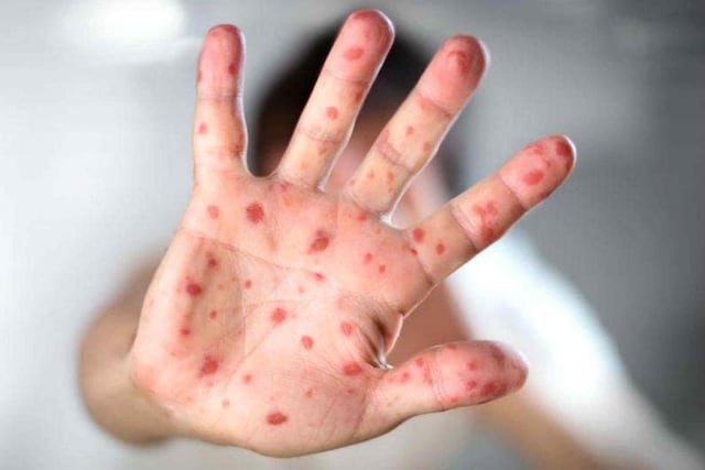 Alerta por Sarampión en Entre Ríos: el Ministerio de Salud provincial advirtió sobre posible exposición