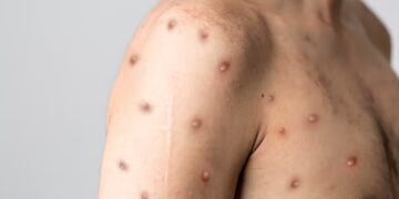 El paciente es un joven de 27 años que tuvo contacto con una persona positiva del virus.